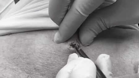 Dr. Lee kocaman bir siyah nokta çıkarıyor Dr. Sandra Lee Cilt Uzmanı Discovery HH_1080p